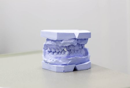 Téléchargez les photos : "Plâtre moulé des dents de plâtre à l'orthodontiste. " - en image libre de droit