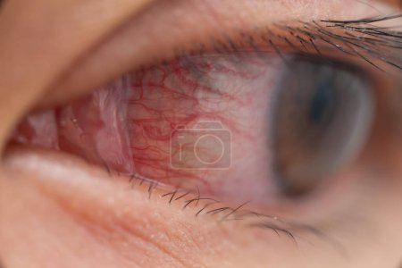 Téléchargez les photos : Gros plan d "œil rouge irrité ou infecté - conjonctivite - en image libre de droit