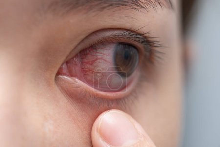 Foto de Acercamiento del ojo rojo irritado o infectado - conjuntivitis - Imagen libre de derechos