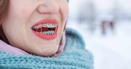 Foto de Chica en la calle sonríe y los aparatos ortopédicos son visibles en sus dientes - Imagen libre de derechos