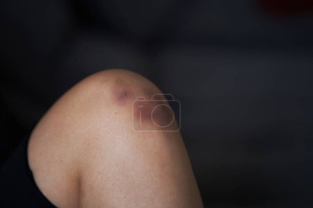 Téléchargez les photos : Gros plan d'une personne massant une articulation du genou blessée. Bleus sur le genou. Douleur aux jambes - en image libre de droit