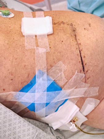 Foto de "El paciente muestra una cicatriz fresca y grande después de una cirugía intestinal y hepática.
" - Imagen libre de derechos