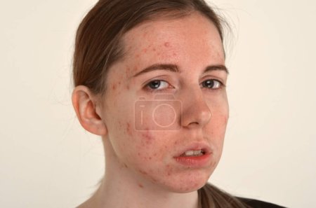 Téléchargez les photos : Belle jeune fille avec la peau problématique, concept de problème d'acné - en image libre de droit