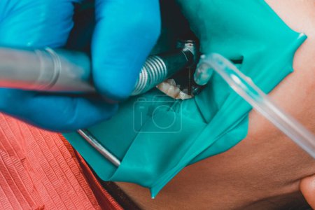 Téléchargez les photos : "dentiste traite la dent avec des méthodes modernes, utilise un barrage en caoutchouc, traitement dentaire stérile." - en image libre de droit