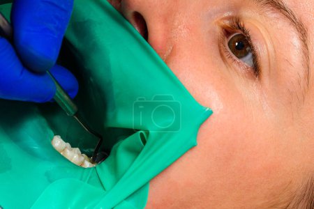 Téléchargez les photos : "traitement d'une dent à mâcher, le dentiste a mis un barrage en caoutchouc, utilise des outils stériles, utilise la technologie moderne." - en image libre de droit