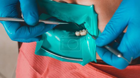 Foto de "El dentista instala una presa de goma, tratamiento dental estéril, equipo moderno en odontología." - Imagen libre de derechos