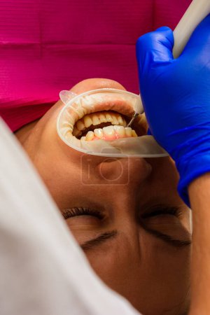 Photo for "At the dentist's appointment, tartar removal, use of ultrasound, patient and dentist. Retractor for isolation of lips and gums." - Royalty Free Image