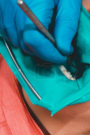 Téléchargez les photos : Traitement de la dent postérieure, bouche recouverte d'un barrage en caoutchouc, traitement stérile avec une technologie moderne - en image libre de droit