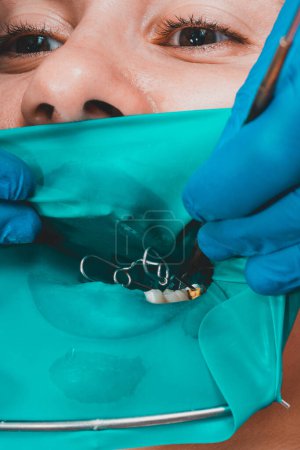 Foto de "Un paciente en una cita con el dentista, un médico utiliza una presa de goma para tratar los dientes, desinfecta un diente para el llenado." - Imagen libre de derechos