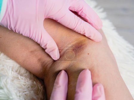 Foto de Un traumatólogo con guantes médicos palpa la pierna lesionada del paciente. Concepto de primeros auxilios para lesiones. - Imagen libre de derechos