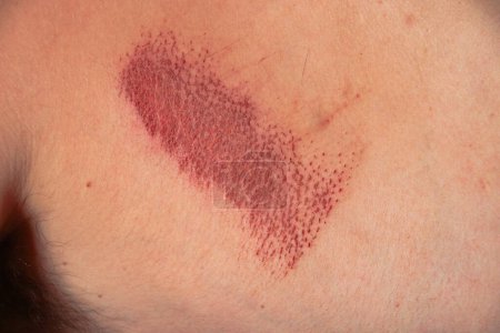 Téléchargez les photos : "Plaie par abrasion sur la peau" - en image libre de droit