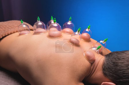 Photo for "Cup massage in general. Vacuum jars for back massage for a man. Massage with vacuum cups. Cupping treatments for back pain relief. Caucasian man lies face down with mounted vacuum cups on his back" - Royalty Free Image