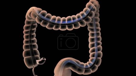 "El sistema digestivo humano. Ilustración 3D de la colonoscopia Procedimiento"