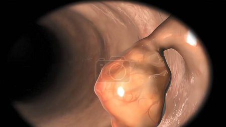 Téléchargez les photos : "Biopsie par coloscopie du tractus gastro-intestinal chez les patients" - en image libre de droit