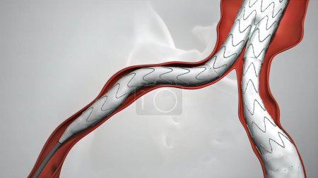 Téléchargez les photos : "procédure d'angioplastie par ballonnet avec endoprothèse dans la veine" - en image libre de droit