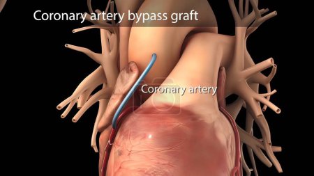 Photo for "Coronary artery bypass surgery is done using a healthy blood vessel called a graft." - Royalty Free Image