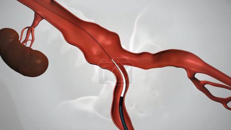 Téléchargez les photos : "procédure d'angioplastie par ballonnet avec endoprothèse dans la veine" - en image libre de droit