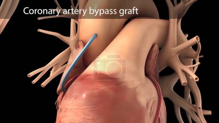 Téléchargez les photos : "Le pontage aortocoronarien se fait à l'aide d'un vaisseau sanguin sain appelé greffe." - en image libre de droit