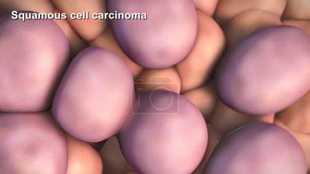 Photo for "Division and growth of cancerous cells" - Royalty Free Image