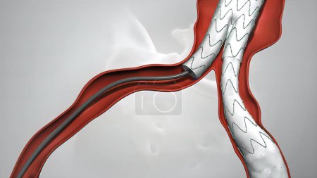 Photo for "balloon angioplasty procedure with stent in vein" - Royalty Free Image