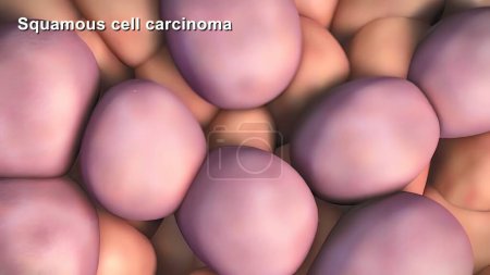 Foto de "División y crecimiento de células cancerosas" - Imagen libre de derechos