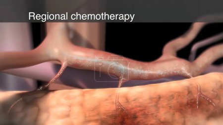 Photo for "Brachytherapy is a type of radiotherapy," - Royalty Free Image