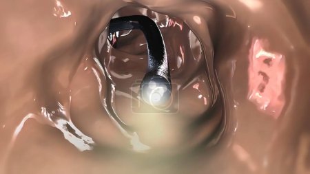 "Biopsie par coloscopie du tractus gastro-intestinal chez les patients"