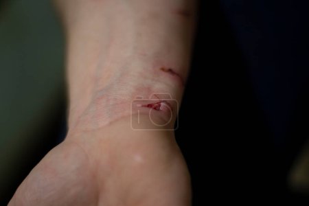 Téléchargez les photos : "Une blessure au bras. Du sang de la coupure. Laine de coton pour enlever le sang sur la peau." - en image libre de droit