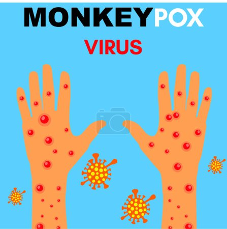 Téléchargez les photos : "Illustration du virus de la variole du singe, vecteur des mains avec la variole du singe, conception pandémique de l'épidémie de virus de la variole du singe avec vue microscopique arrière-plan" - en image libre de droit