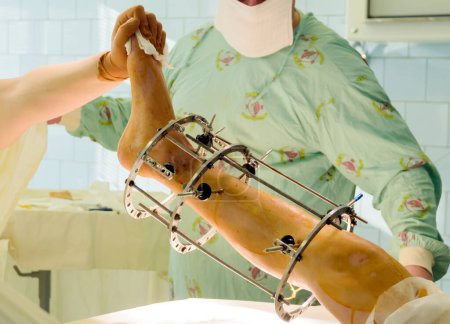 Téléchargez les photos : Technique de fixation externe des anneaux en médecine orthopédique - en image libre de droit