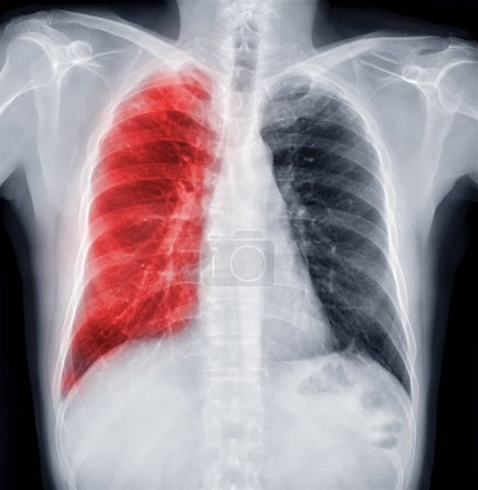 Téléchargez les photos : "Radiographie thoracique de la poitrine humaine ou du poumon pour détecter la tuberculose" - en image libre de droit