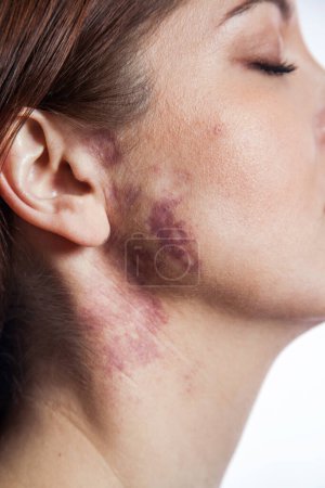Photo for "woman with real port wine stain birthmark on her face," - Royalty Free Image