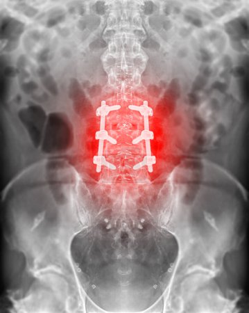 Téléchargez les photos : "Image radiographique de la colonne vertébrale lombaire avec fixation par vis pédiculaire." - en image libre de droit