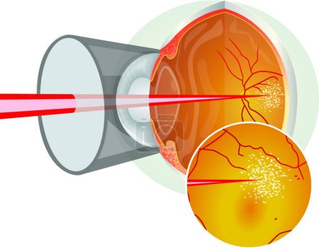 Téléchargez les illustrations : Chirurgie oculaire au laser, illustration vectorielle graphique - en licence libre de droit