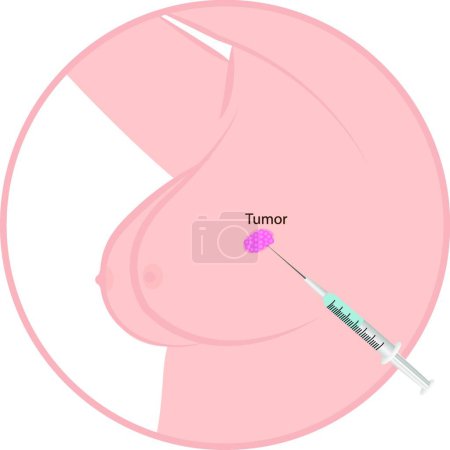 Téléchargez les illustrations : Tumeur du cancer du sein, illustration graphique - en licence libre de droit