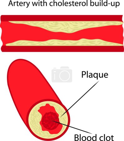 Illustration for "cholesterol plaque in artery" - Royalty Free Image