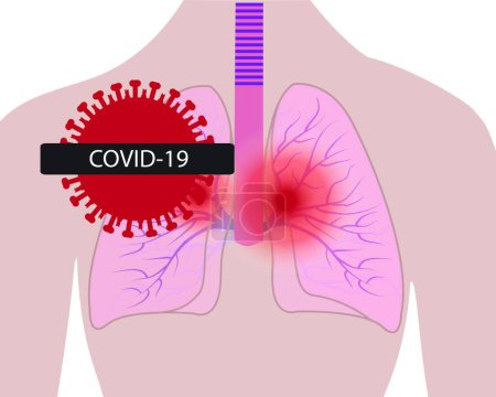 Illustration for "Lungs affected with coronavirus infection COVID19" - Royalty Free Image