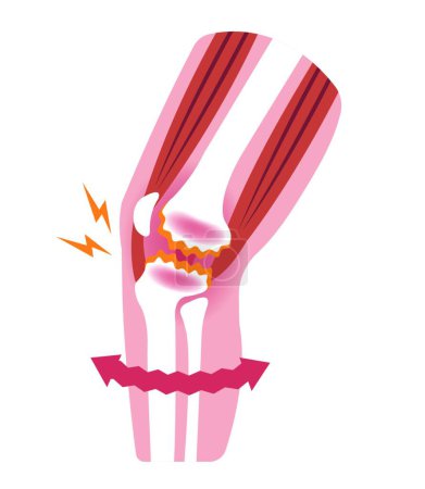 Illustration for "Knee joint pain (gonarthrosis / osteoarthritis / arthrosis of knee ) . flat illustration" - Royalty Free Image