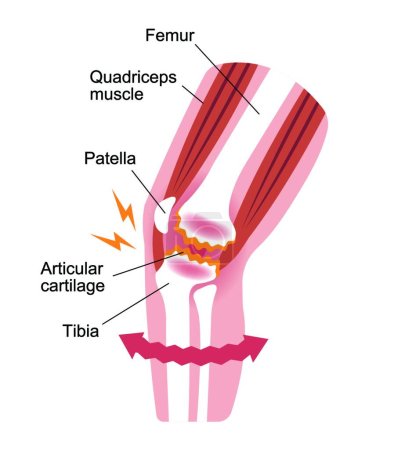 Illustration for "Knee joint pain (gonarthrosis / osteoarthritis / arthrosis of knee ) . flat illustration" - Royalty Free Image