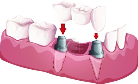 Ilustración de "Puente dental "icono web vector ilustración - Imagen libre de derechos