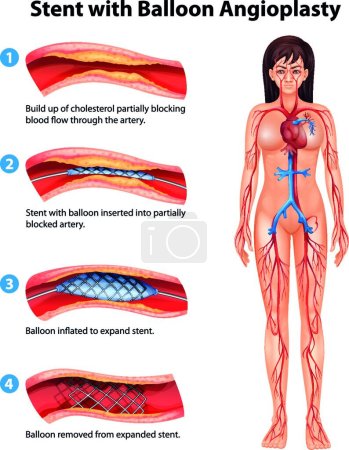 Ilustración de Procedimiento de angioplastia con stent, ilustración gráfica vectorial - Imagen libre de derechos