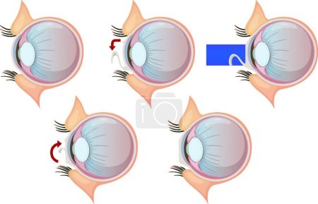 Téléchargez les illustrations : Correction des yeux au laser, illustration vectorielle graphique - en licence libre de droit
