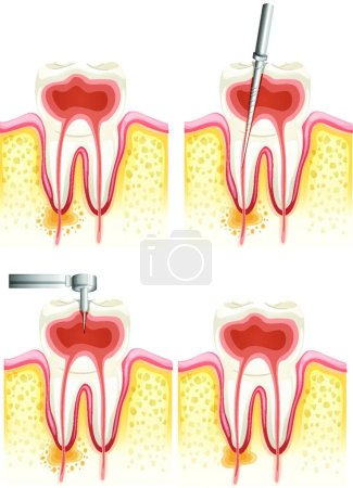 Illustration for "Dental root canal"  web icon vector illustration - Royalty Free Image