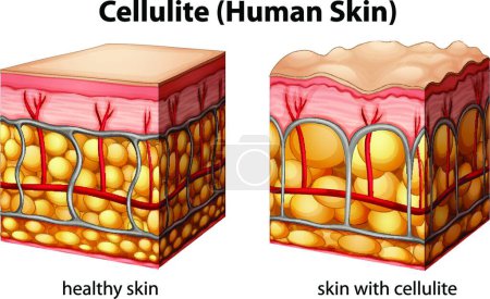 Illustration for Illustration of the Cellulite - Royalty Free Image