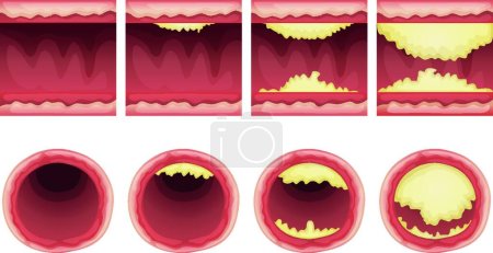 Illustration for Illustration of the Ateriosclerosis - Royalty Free Image