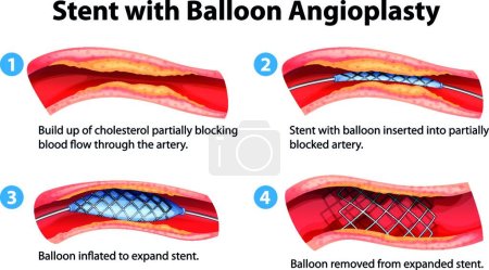 Ilustración de Ilustración del procedimiento de angioplastia con stent - Imagen libre de derechos