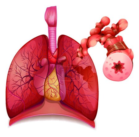 Téléchargez les illustrations : Illustration de l'asthme - en licence libre de droit