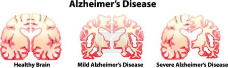 Ilustración de Ilustración de la enfermedad de Alzheimer - Imagen libre de derechos