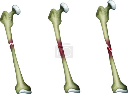 Illustration for Illustration of the bone fracture - Royalty Free Image