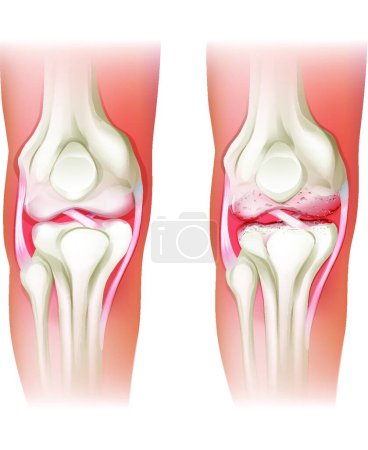 Ilustración de Ilustración de la artritis de rodilla humana - Imagen libre de derechos